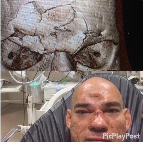 evangelista-santos-lesion