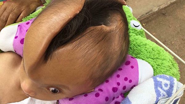 Niño con la cabeza partida en dos (1)